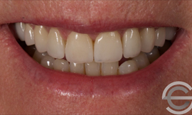 Porcelain Veneers