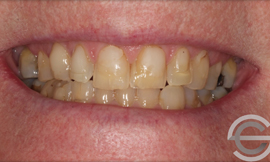 Porcelain Veneers