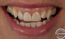 Porcelain Veneers