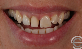 Porcelain Veneers