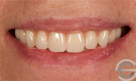 Cosmetic Complete Dentures