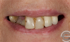 Cosmetic Complete Dentures