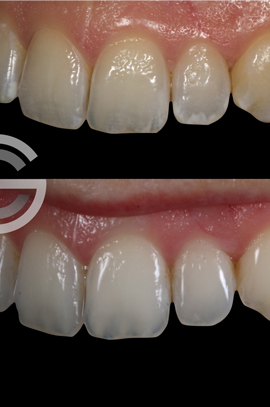 Tooth whitening and Icon white spot treatment