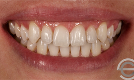 Tooth whitening and Icon white spot treatment