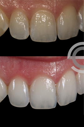 Tooth whitening and Icon white spot treatment