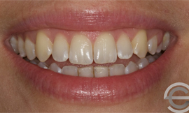 Tooth whitening and Icon white spot treatment