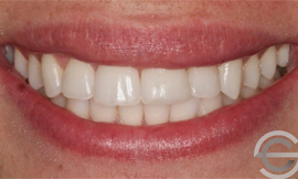 Tooth whitening and Icon white spot treatment