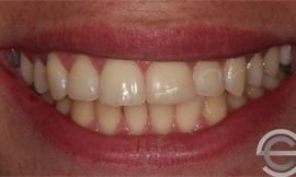 Tooth whitening and Icon white spot treatment