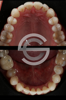 12 months Invisalign and tooth whitening