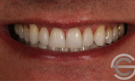 12 months Invisalign and tooth whitening