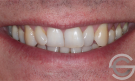 12 months Invisalign and tooth whitening