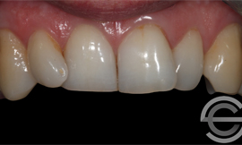 12 months Invisalign and tooth whitening
