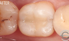 Amalgam replacement with cosmetic white filling
