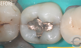 Amalgam replacement with cosmetic white filling