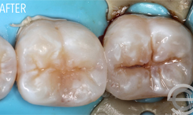 Two cosmetic white fillings