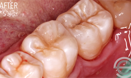 Two cosmetic white fillings