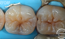 Two cosmetic white fillings