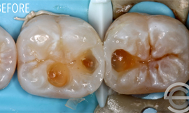 Two cosmetic white fillings