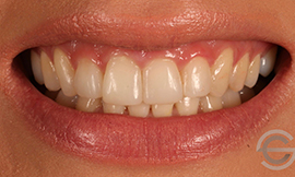 Amalgam replacement with cosmetic white filling
