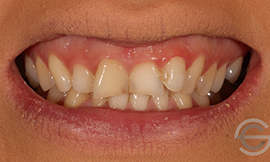 Amalgam replacement with cosmetic white filling