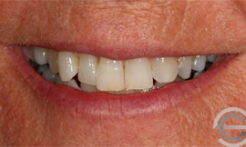 Tooth whitening