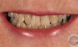 Tooth whitening