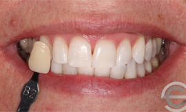 Tooth whitening