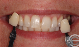 Tooth whitening