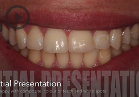 Tooth whitening, DMG Icon and cosmetic bonding by Dr Simon Chard