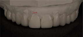 Wax mock-up and trial smile