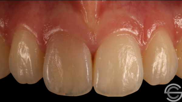 Dark Front Tooth